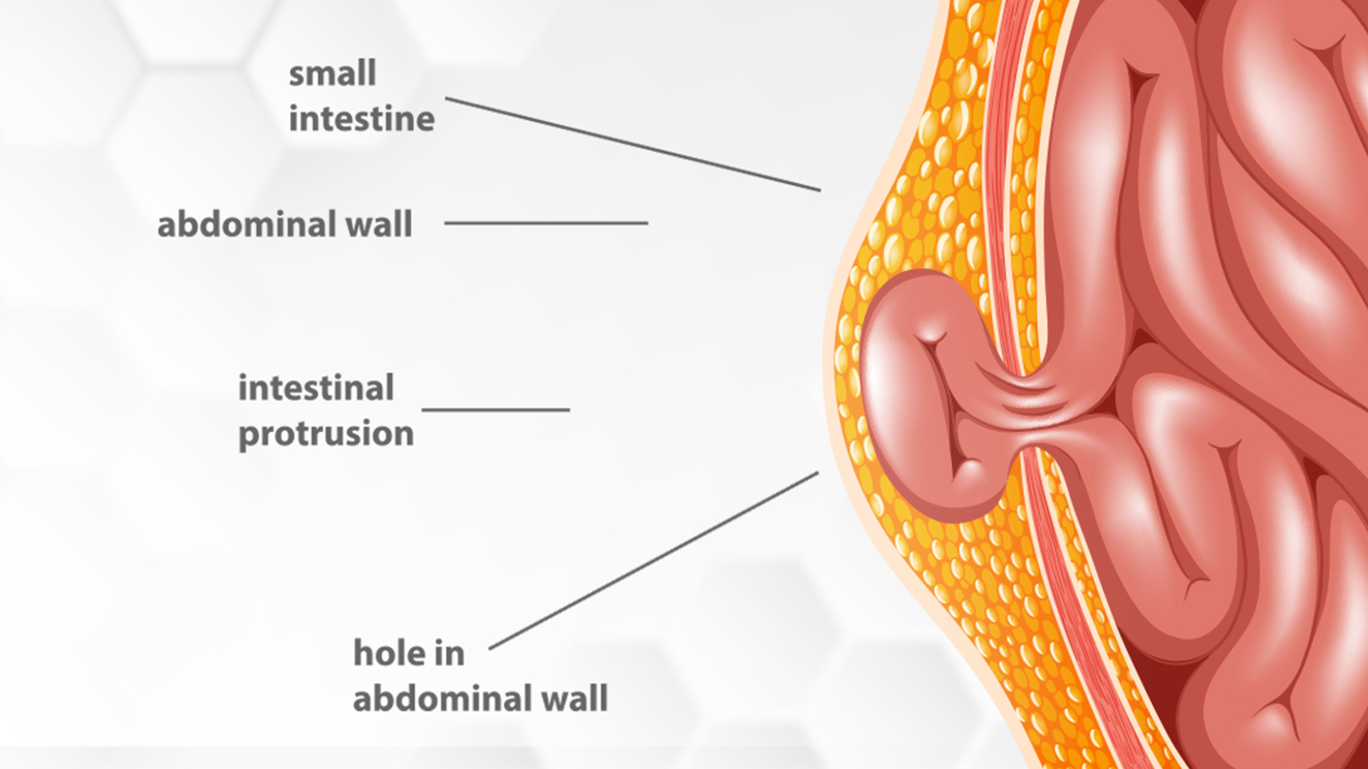 Hernia & Its Types