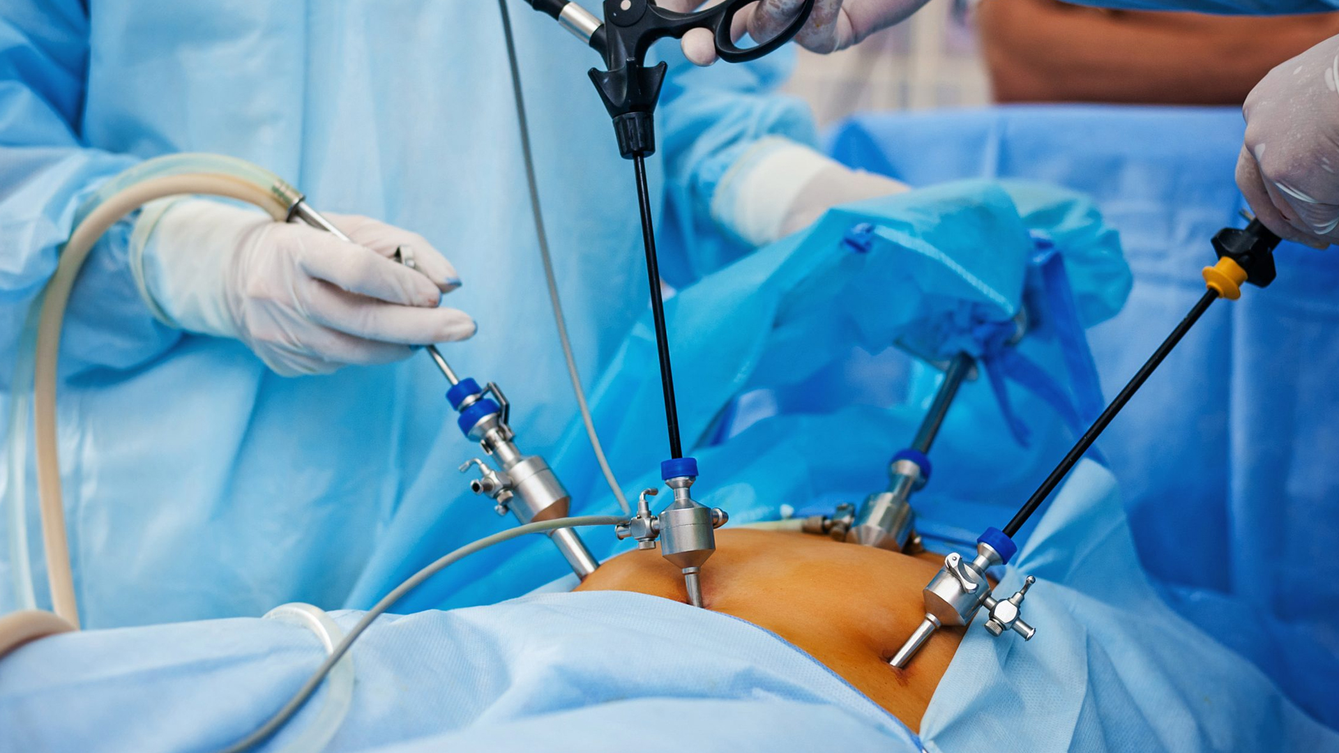 Laparoscopic Surgery and Its Benefits